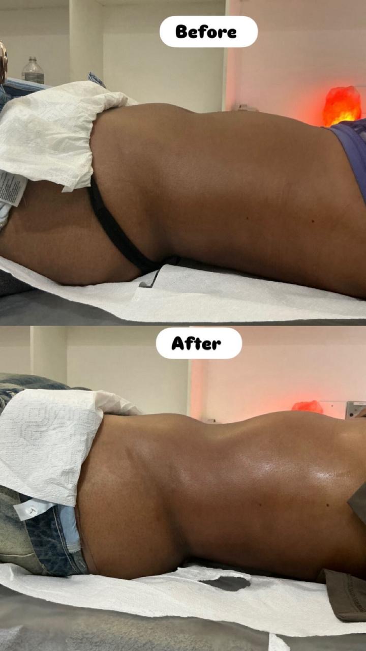 Before and after Wood therapy · midsection at Bodywood by Thando