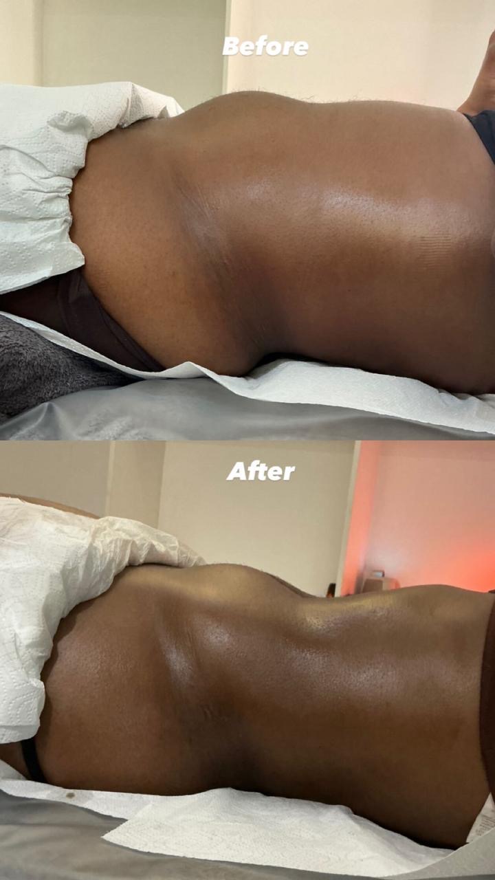 Before and after Wood therapy · waist & flanks at Bodywood by Thando